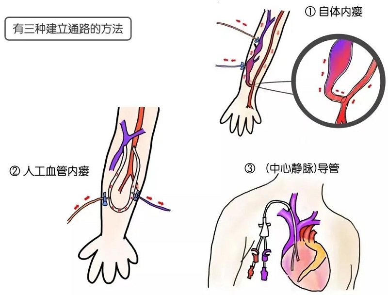 血管通路多學(xué)科診療模式，守護(hù)血透患者“生命線”