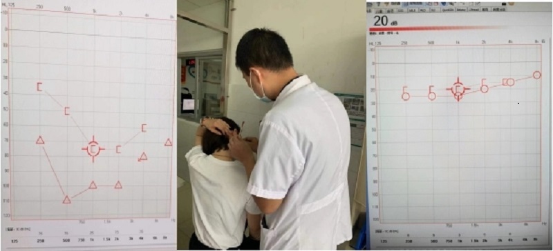 突發(fā)性耳聾被治愈！萬載縣人民醫(yī)院成功開展耳后、鼓室內(nèi)給藥技術(shù)