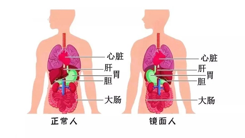 百萬分之一罕見“鏡面人”！五臟六腑反著長，手術(shù)也得反著來！