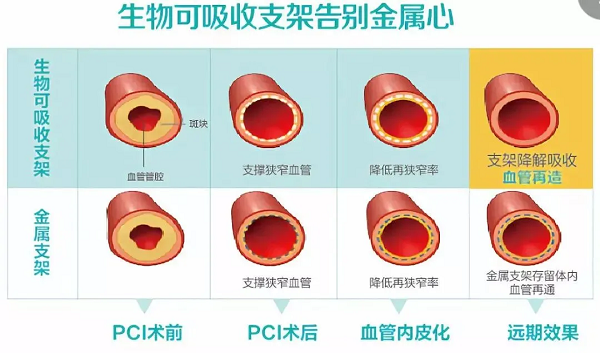 冠心病患者福音！我院成功完成首例可吸收支架植入！