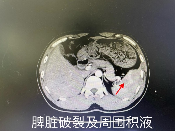 萬(wàn)載縣首例——我院肝膽外科成功自主實(shí)施一例高難度全腹腔鏡下全脾切除術(shù)