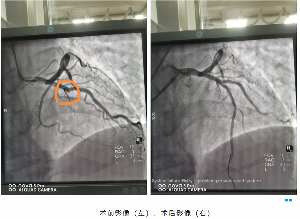 與死神賽跑，為生命接力——我院成功 搶救一名急性心肌梗死患者